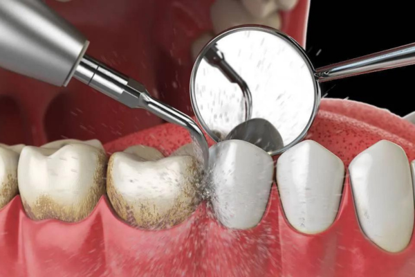 Détartrage, surfaçage